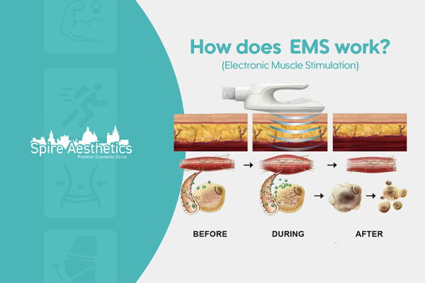 EMS treatment for post pregnancy weight loss treatment Beccles