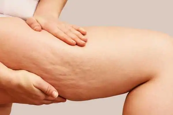 Image of woman showing leg with cellulite Beccles