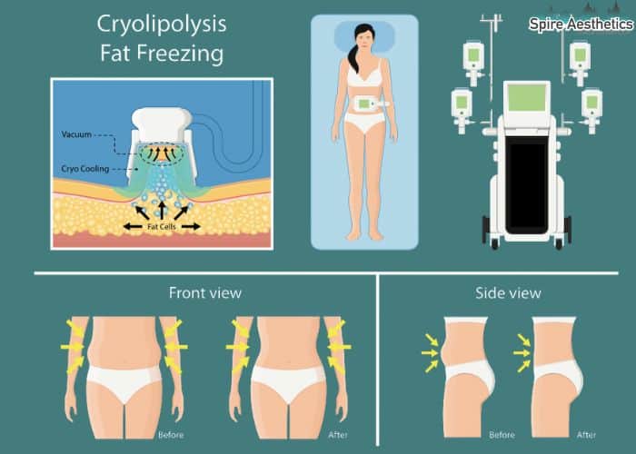 Image of diet and fat freezing combined for best results for Spire Aesthetics Beccles