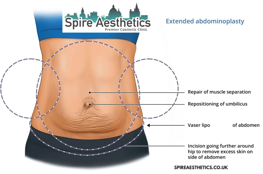 Understanding Loose Skin After Gastric Band Beccles Surgery and HIFU Treatment