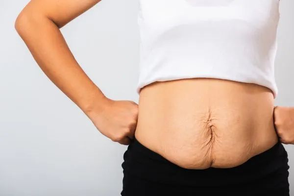 Image of a woman's stomach after weight loss with sagging skin following a gastric band Beccles
