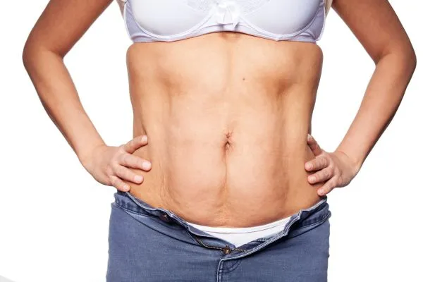 sagging skin on woman's stomach after weight loss injections Beccles