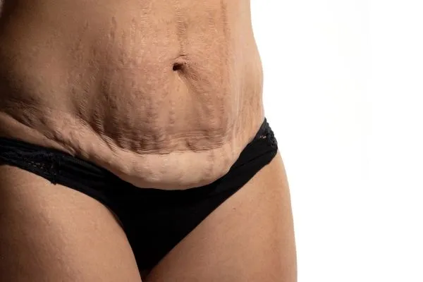 Image of womans stomach after weight loss injections Beccles showing saggy skin